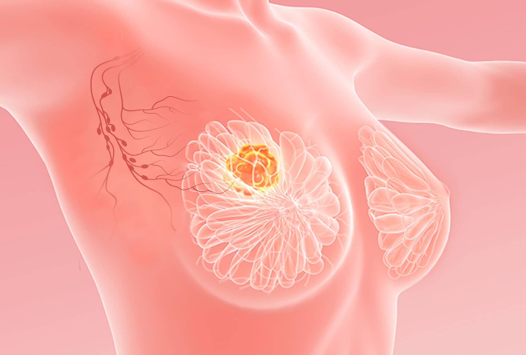 Chirurgie (curage) ganglionnaire cancer du sein | L’Institut du Sein