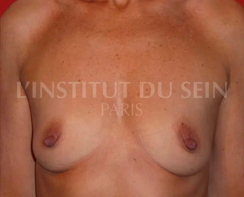 Poitrine avant la chirurgie lipofilling mammaire sur les deux sein institut du sein paris