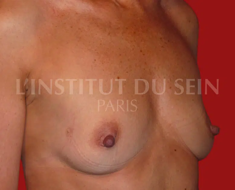 Poitrine avant lipofilling sur les deux sein institut du sein paris