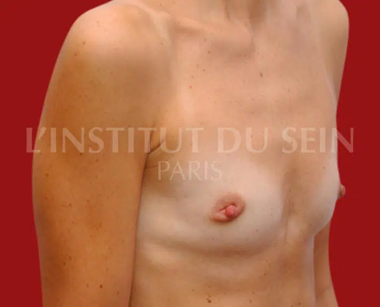 Poitrine avant Deux lipofillings et abaissement des sillons sous mammaires institut du sein paris