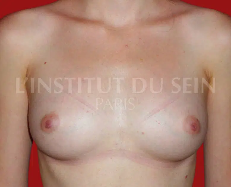 Poitrine apres chirurgie de lipofilling sur les deux sein institut du sein paris