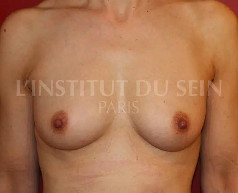Poitrine apres chirurgie lipofilling sur les deux sein institut du sein paris