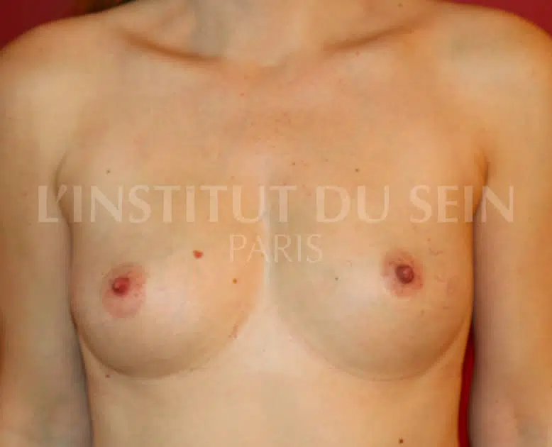 Poitrine apres lipofillings abaissement des sillons sous mammaires institut du sein paris