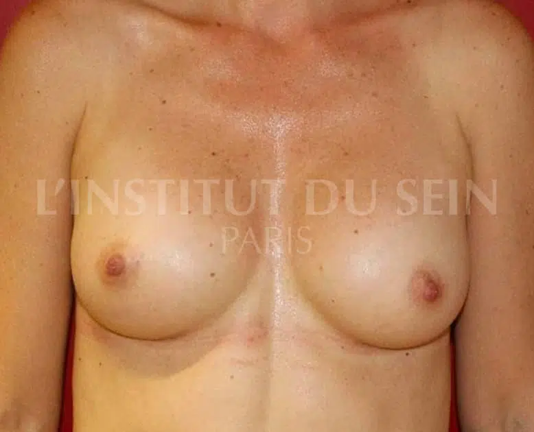 Poitrine apres pose de protheses dual plane et un filling sur les deux seins institut du sein paris