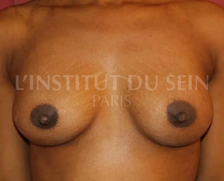 Poitrine apres pose de protheses retropectorales dual plan institut du sein paris