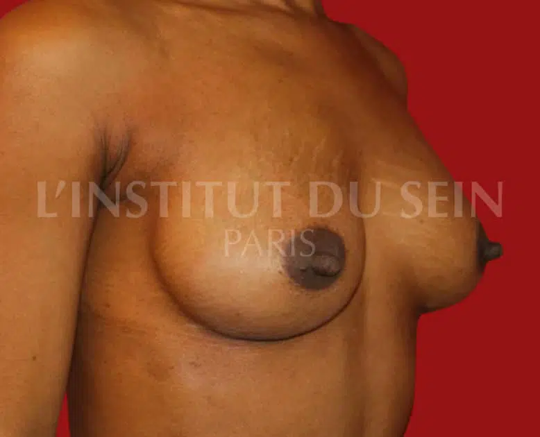 Poitrine apres augmentation par protheses dual plan et abaissement des sillons institut du sein paris