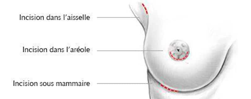 implanter une prothèse mammaire : les types d'incisions : sous-mammaire, dans l'aréole ou dans l'aisselle - Institut du Sein Paris