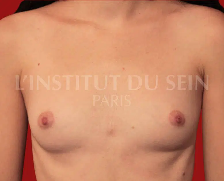 Poitrine avant une operation esthetique le lipofilling sur les deux sein institut du sein paris