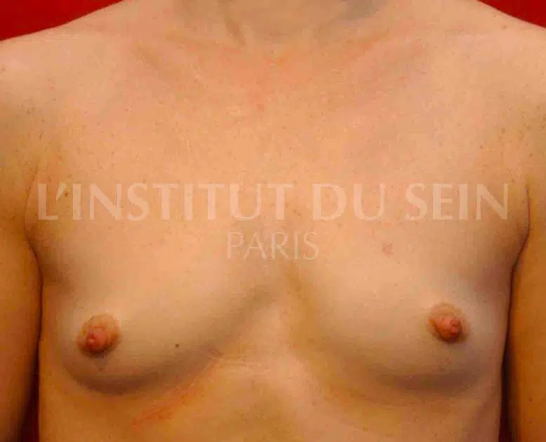 Poitrine avant lipofilling sur les deux sein institut du sein paris