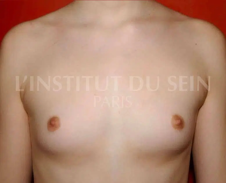 Poitrine avant pose de deux protheses par dual plane institut du sein paris