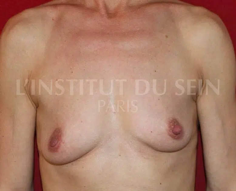 Poitrine avant pose de protheses retro pectorales dualplan institut du sein paris