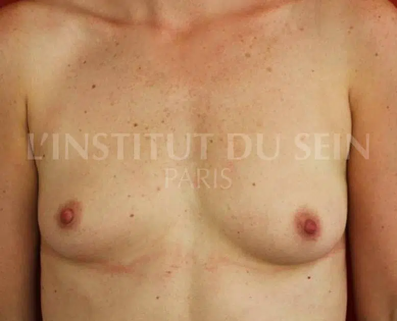Poitrine avant pose de protheses dual plane et un filling sur les deux seins institut du sein paris