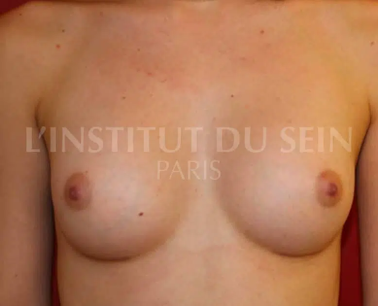 Poitrine avant pose de protheses prepectorales et filling institut du sein paris