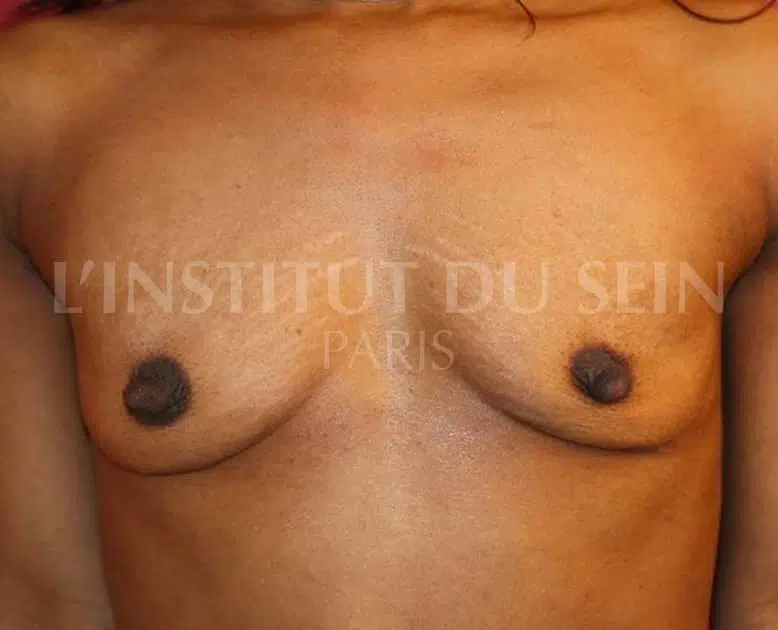 Poitrine avant augmentation par protheses dual plan et abaissement des sillons sous mammaire institut du sein paris