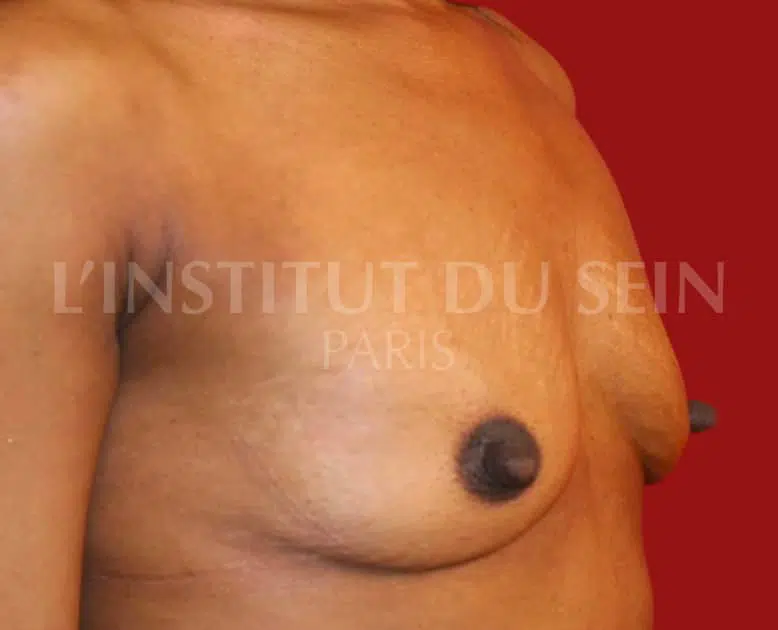 Poitrine avant pose de protheses prepectorales institut du sein paris