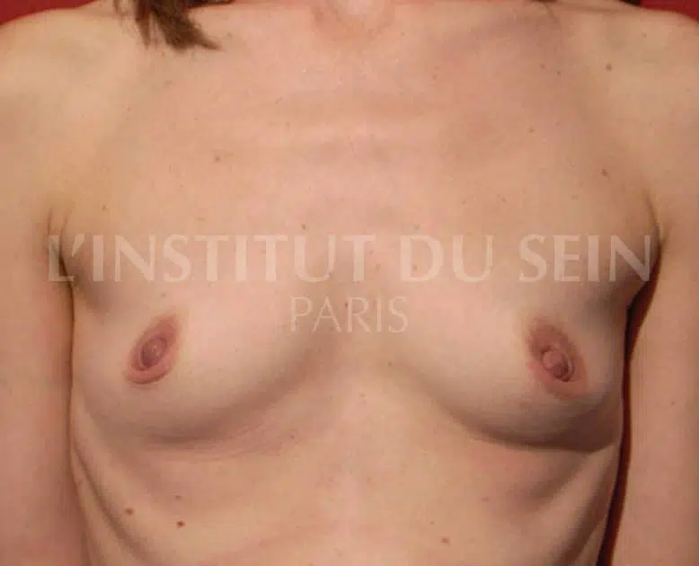 Poitrine avant protheses de sein dual plane institut du sein paris