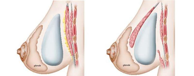 l'implant mammaire est à jouter en avant ou en arrière du muscle pectoral - Institut du Sein Paris