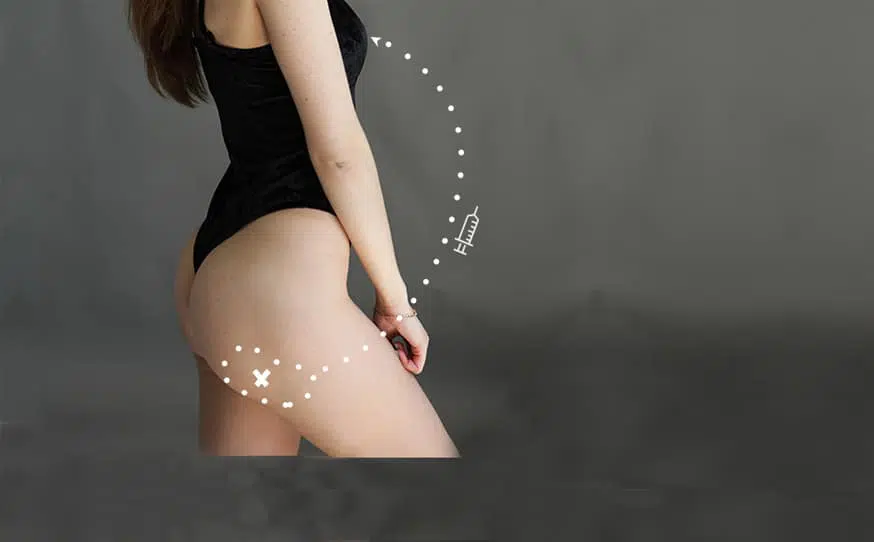 Image de femme representant le filling chirurgie esthetique institut du sein paris
