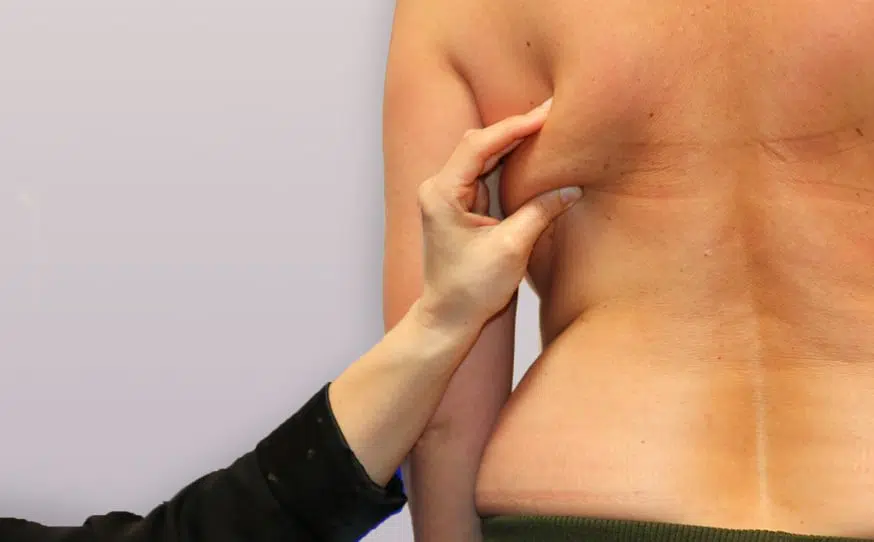 Excedent cutaneo-graisseux utilise en reconstruction mammaire par lambeau de grand dorsal institut du sein paris