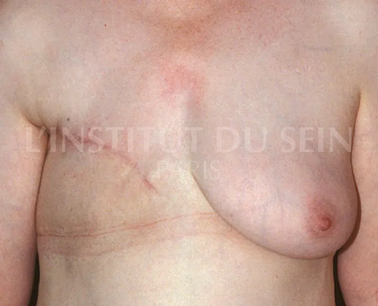 Poitrine apres reconstitution immediate du sein droit par diep institut du sein paris
