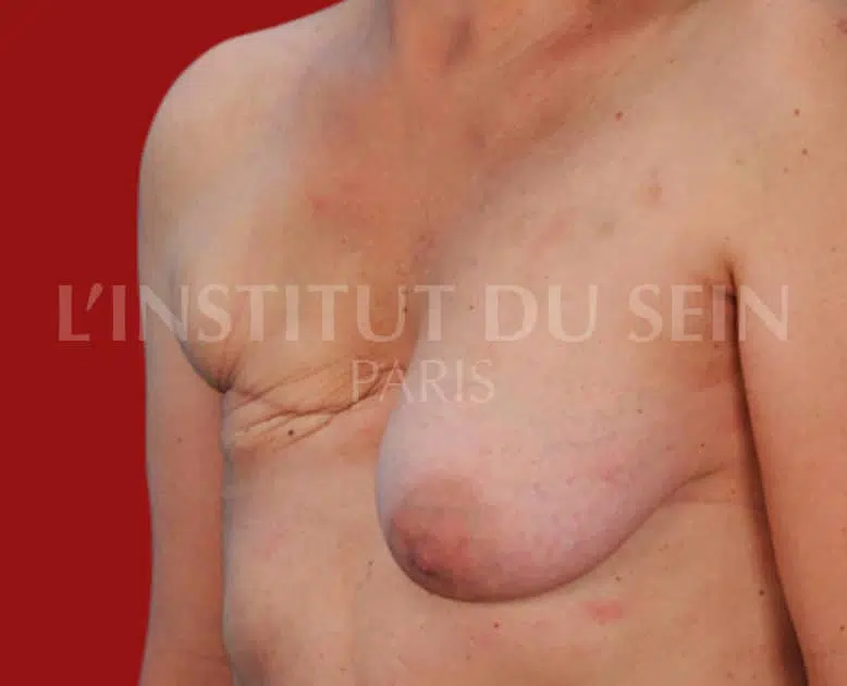 Poitrine apres reconstitution du sein droit par diep et gauche par protheses institut du sein paris