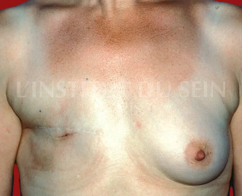 Poitrine apres reconstitution immediate du sein droit par diep institut du sein paris