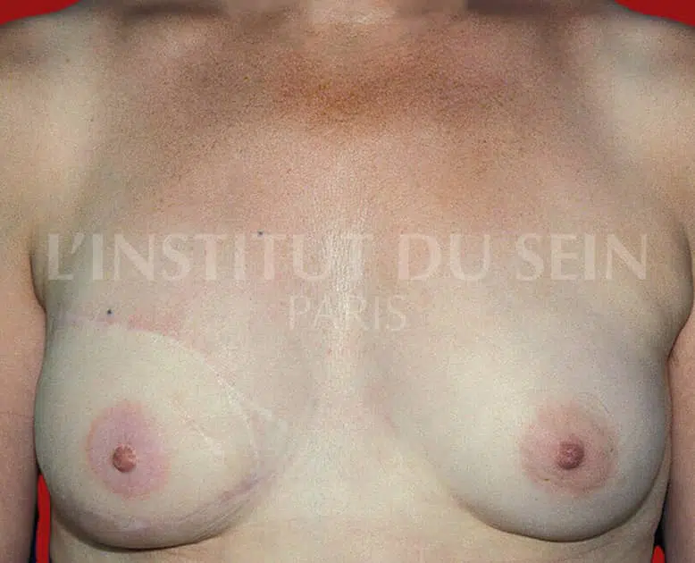 Image de Poitrine apres reconstruction du sein droit par diep institut du sein paris
