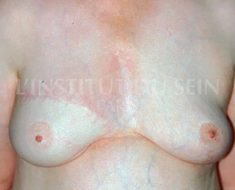 Poitrine apres reconstruction droite par diep et plastie de reduction sein gauche institut du sein paris
