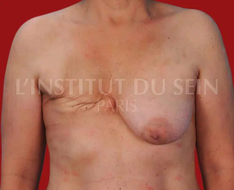 Poitrine avant reconstruction du sein droit par diep institut du sein paris