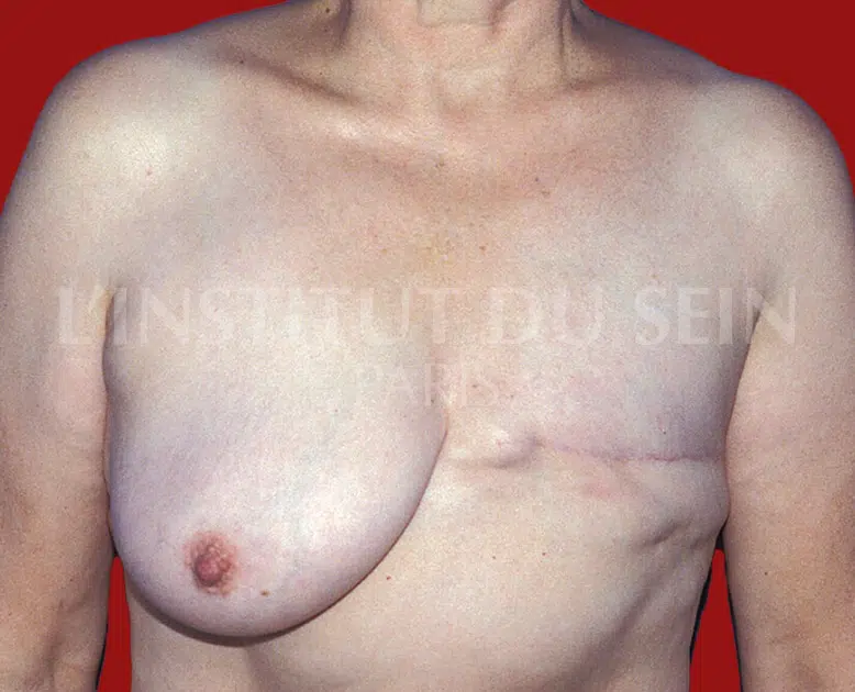 Poitrine avant reconstruction du sein gauche par diep institut du sein paris
