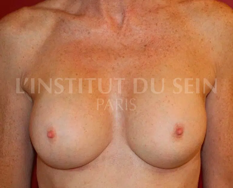 Poitrine avec Protheses prepectorales Coque grade 3 apres Changement de protheses et Lipofilling institut du sein paris