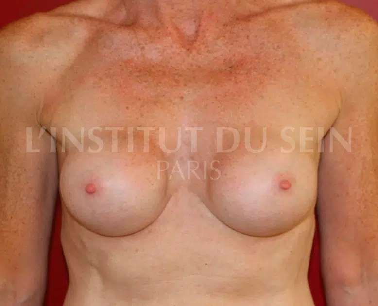 Poitrine avec Protheses prepectorales Coque grade 3 avant Changement de protheses et Lipofilling institut du sein paris