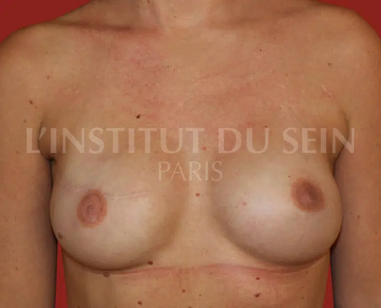 Poitrine avec mastectomie prophylactique apres reconstruction par protheses a l'institut du sein paris
