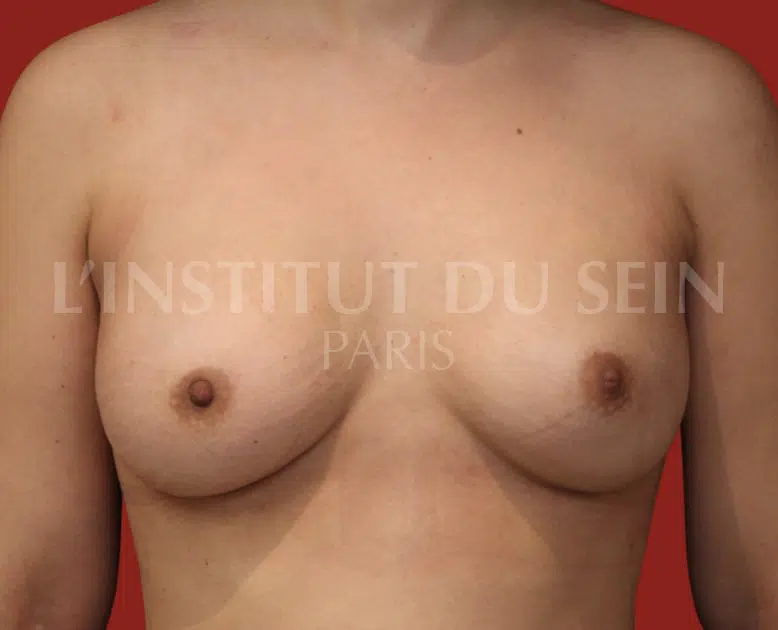Photo de poitrine avec mastectomie prophylactique bilaterale apres reconstruction par protheses a l'institut du sein paris