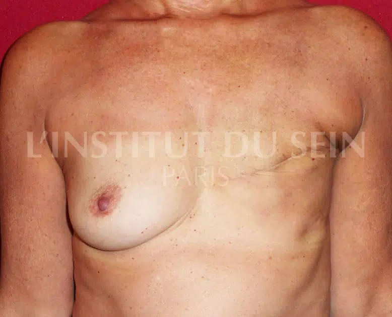 Poitrine avant reconstruction apres radiotherapie prothese et lipofilling prothese sein droit institut du sein paris
