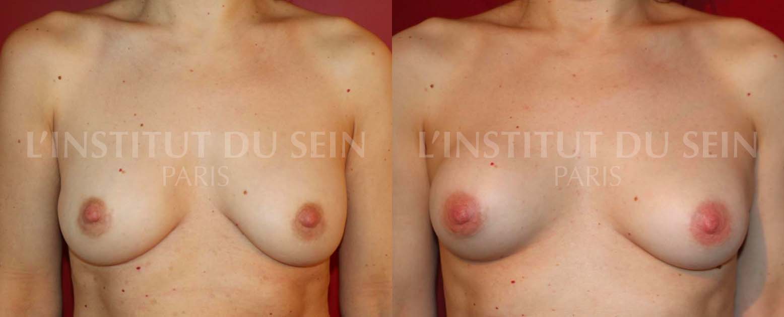 Avant/Apres une coque du sein droit | L'Institut du Sein Paris