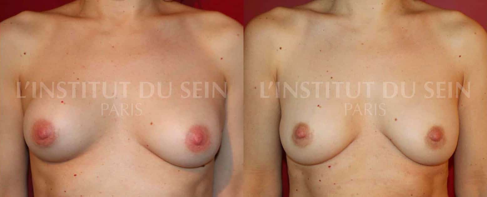 Avant/Apres une coque du sein droit | L'Institut du Sein Paris