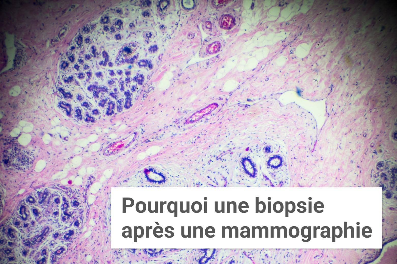 Pourquoi une biopsie après une mammographie ? | Institut du Sein | Paris