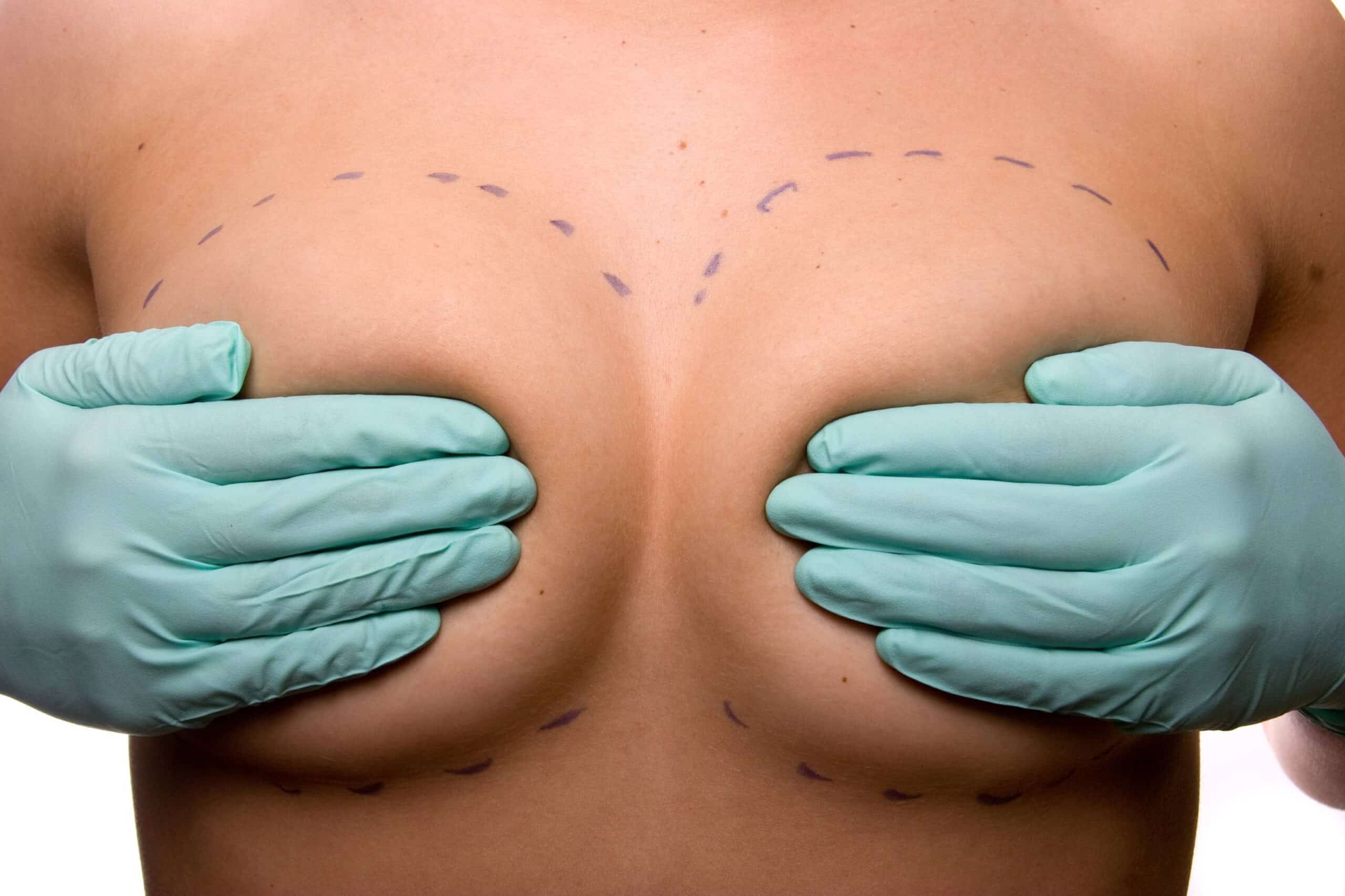 Augmentation mammaire : les différentes techniques ? | Institut du Sein | Paris