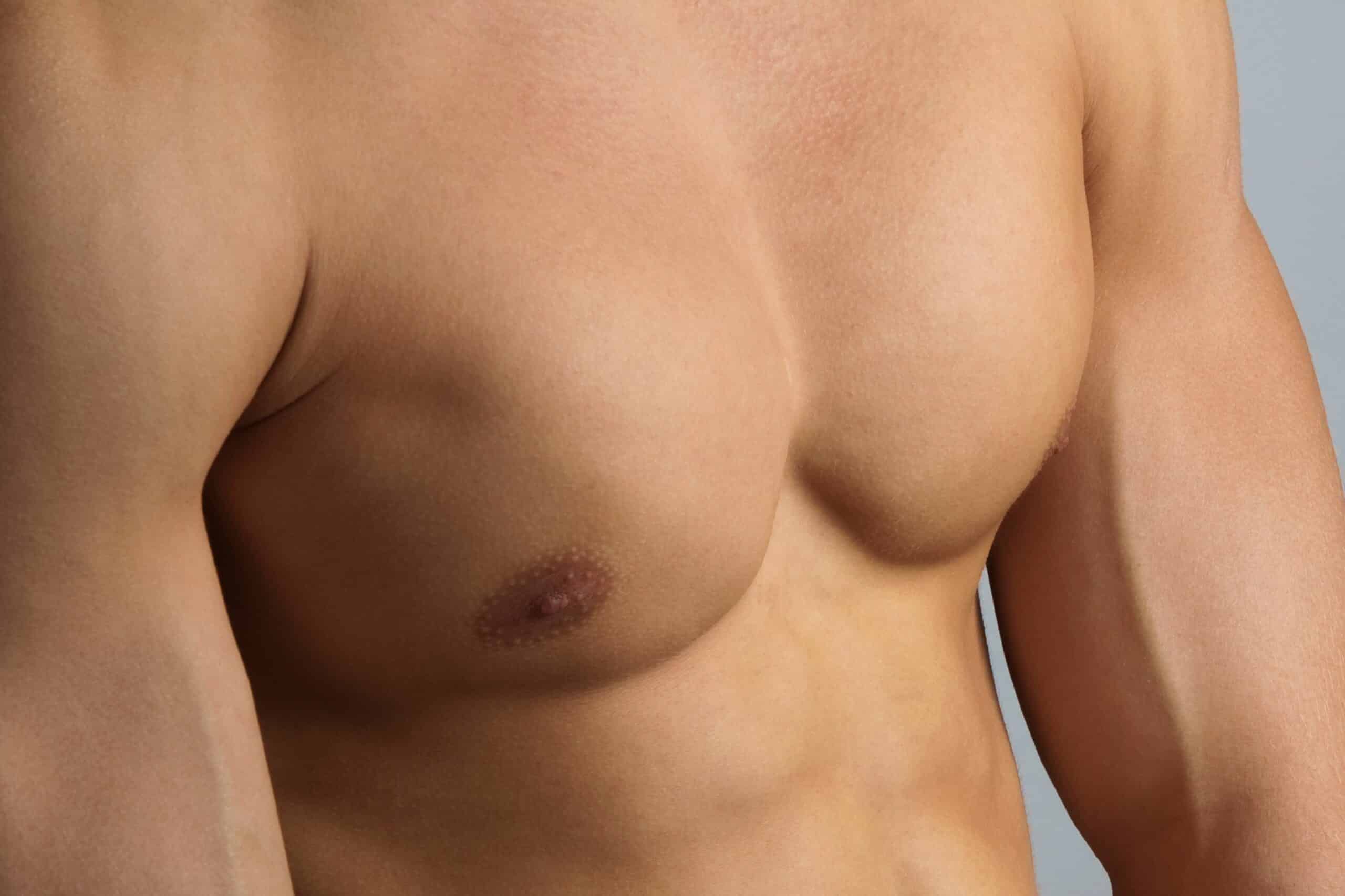 Chirurgie pour gynécomastie