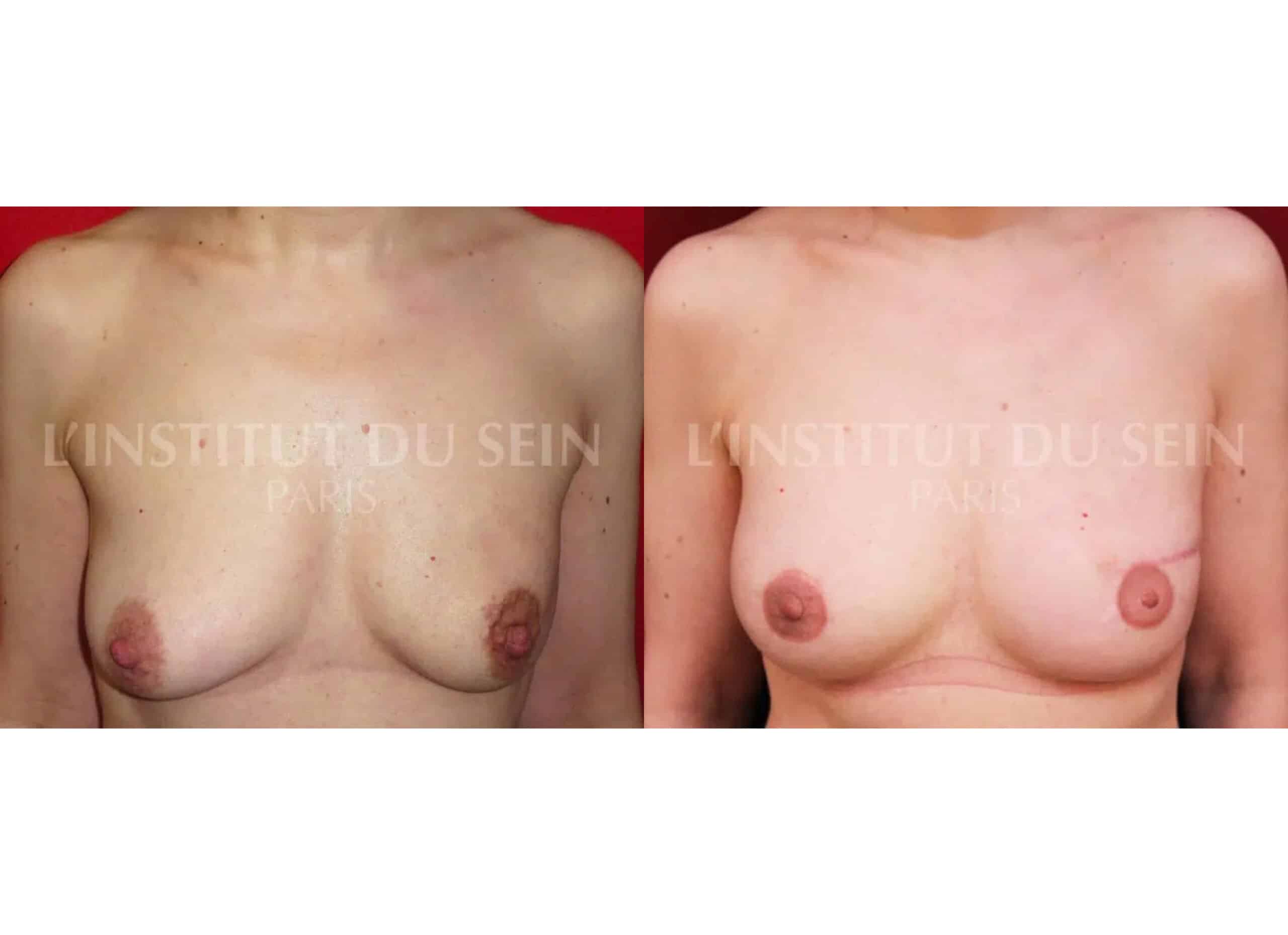 Poitrine avant/aprés mastectomie gauche reconstruction immediate par prothese et filling prothese sein droit et redrapage institut du sein paris