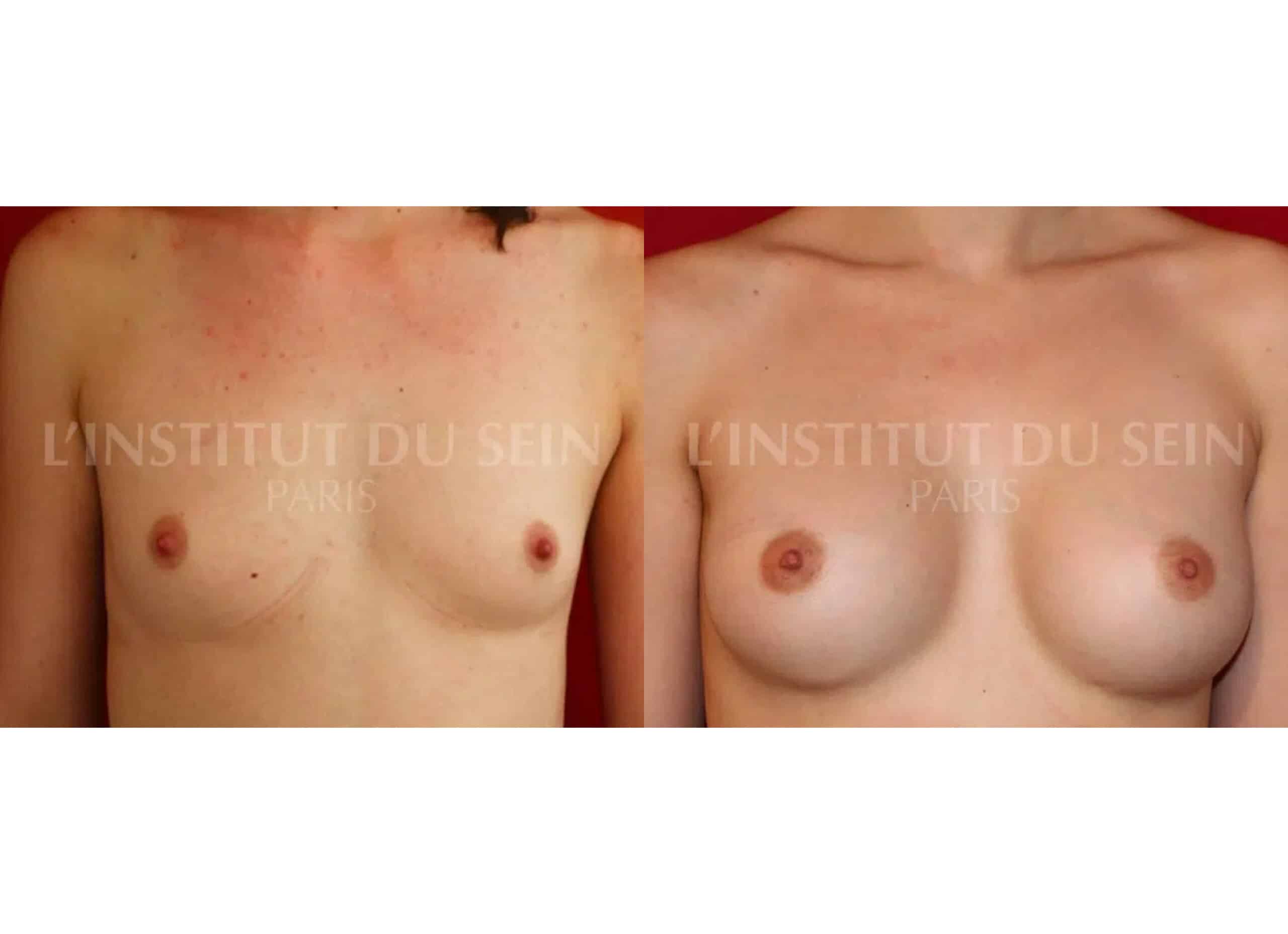 Poitrine avant/apres augmentation par protheses retropectorales dual plan et abaissement des sillons sous mammaires institut du sein paris