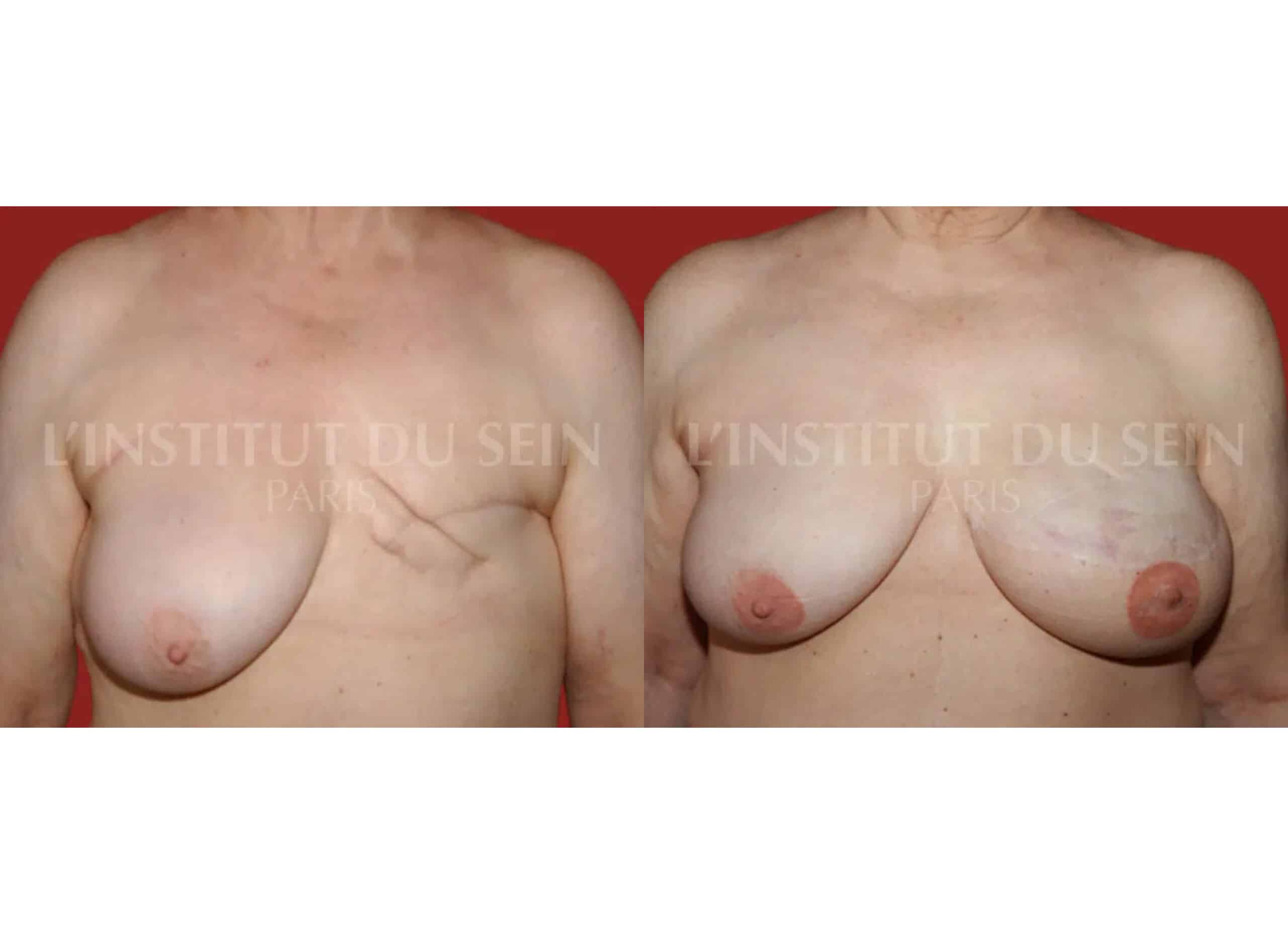 Poitrine avant/apres reconstruction immediate sein gauche par grand Dorsal et prothese sein droit institut du sein paris