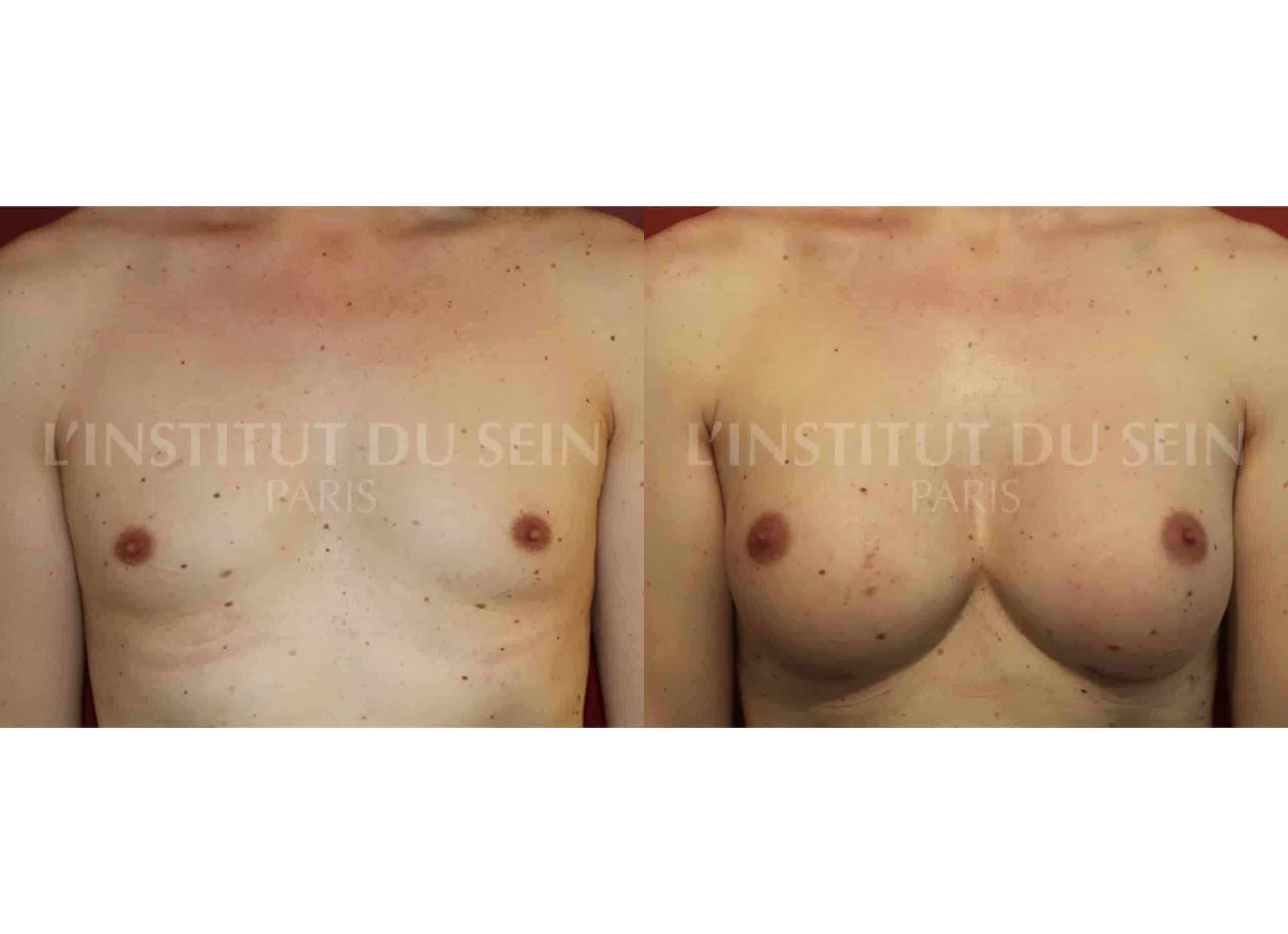 Poitrine trans avant/apres augmentation compositeet pose prothses prepectorale et filling chirurgie transgenre institut du sein paris