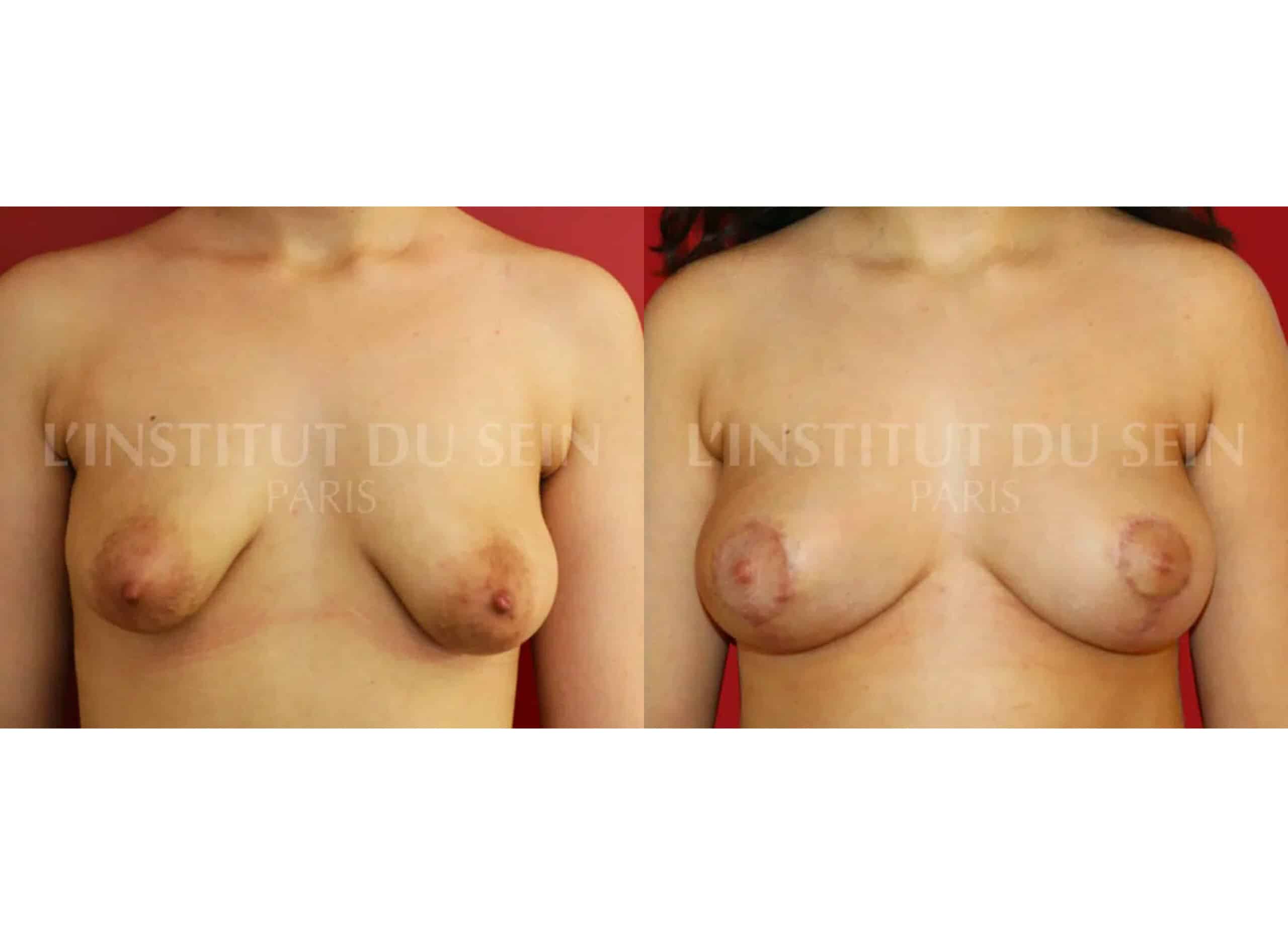 Poitrine avant/aprés lipofilling bilateral et traitement de la ptose par cicatrice institut du sein paris