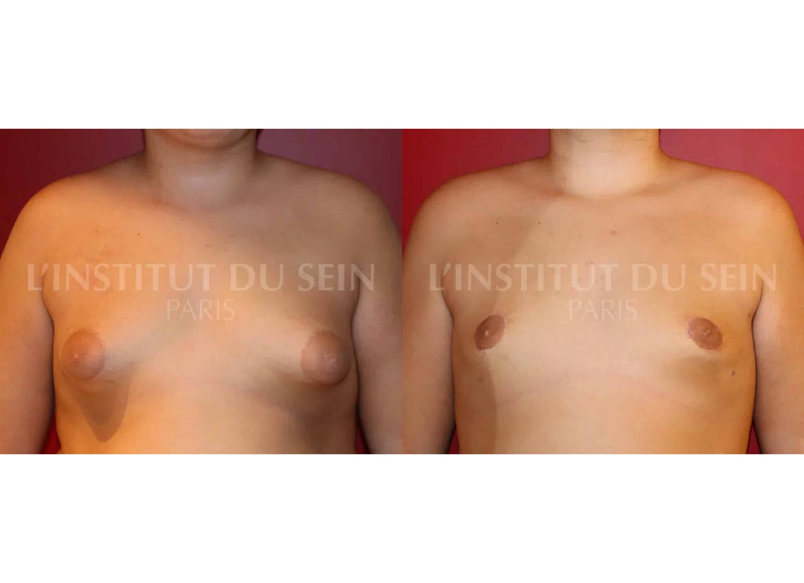 Poitrine homme avant/aprés gynecomastie lipoaspiration reduction de la taille des areoles par cicatrice periareolaire institut du sein paris