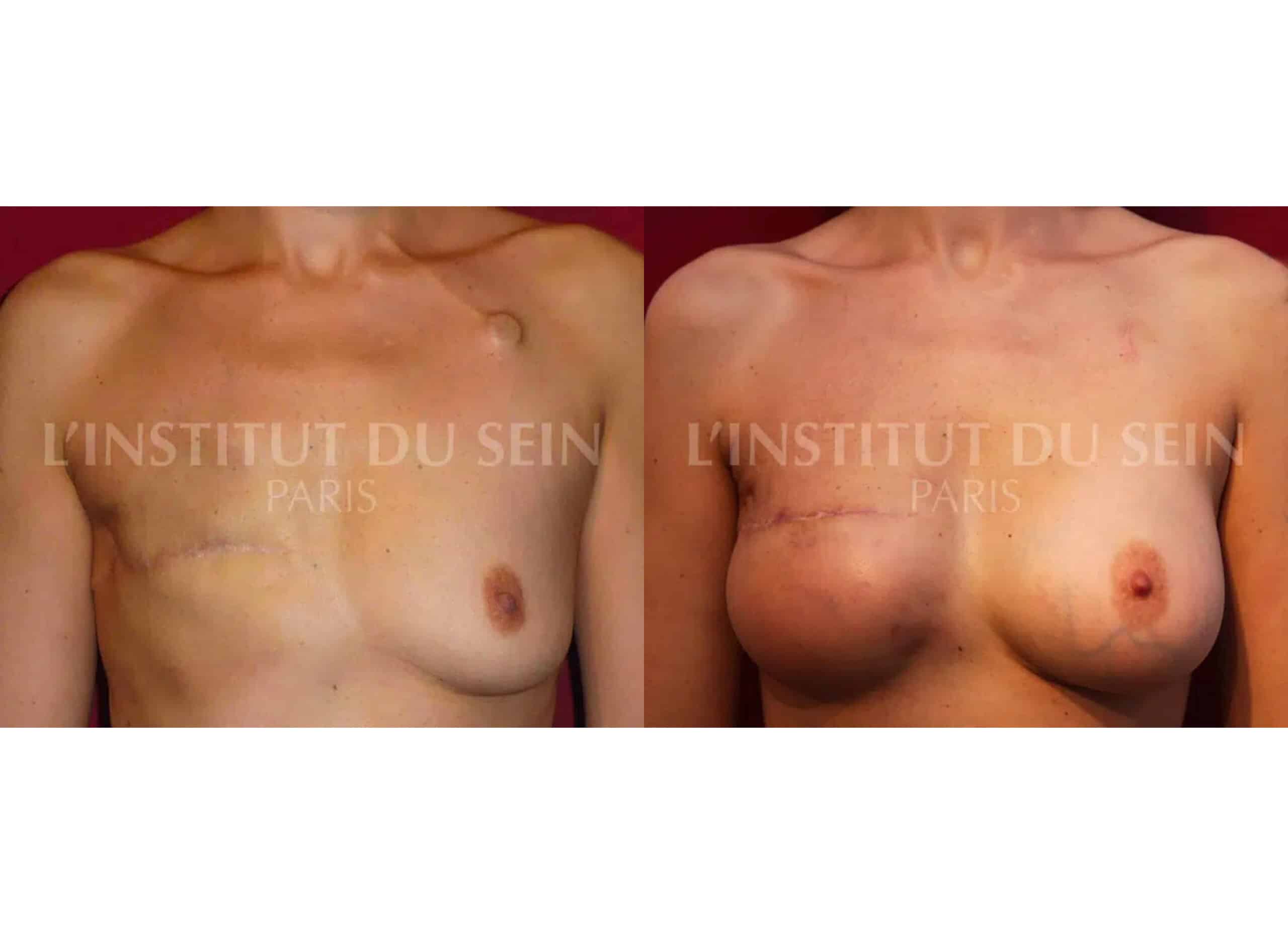 Poitrine avant/apres reconstruction apres radiotherapie prothese et lipofilling prothese sein gauche institut du sein paris
