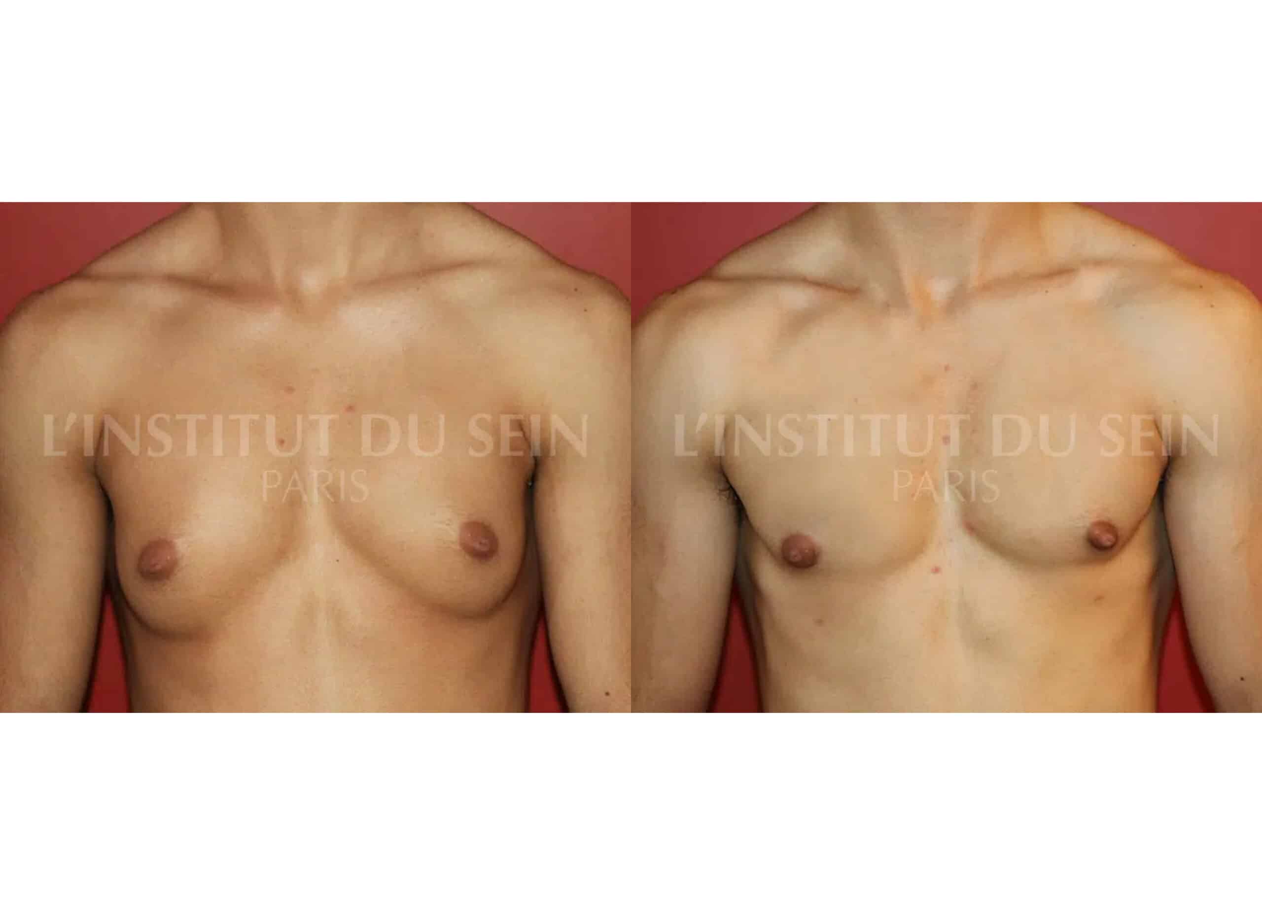 Poitrine Trans homme avant/aprés mastertomie par une cicatrice sous areolaire chirurgie transgenre institut du sein paris