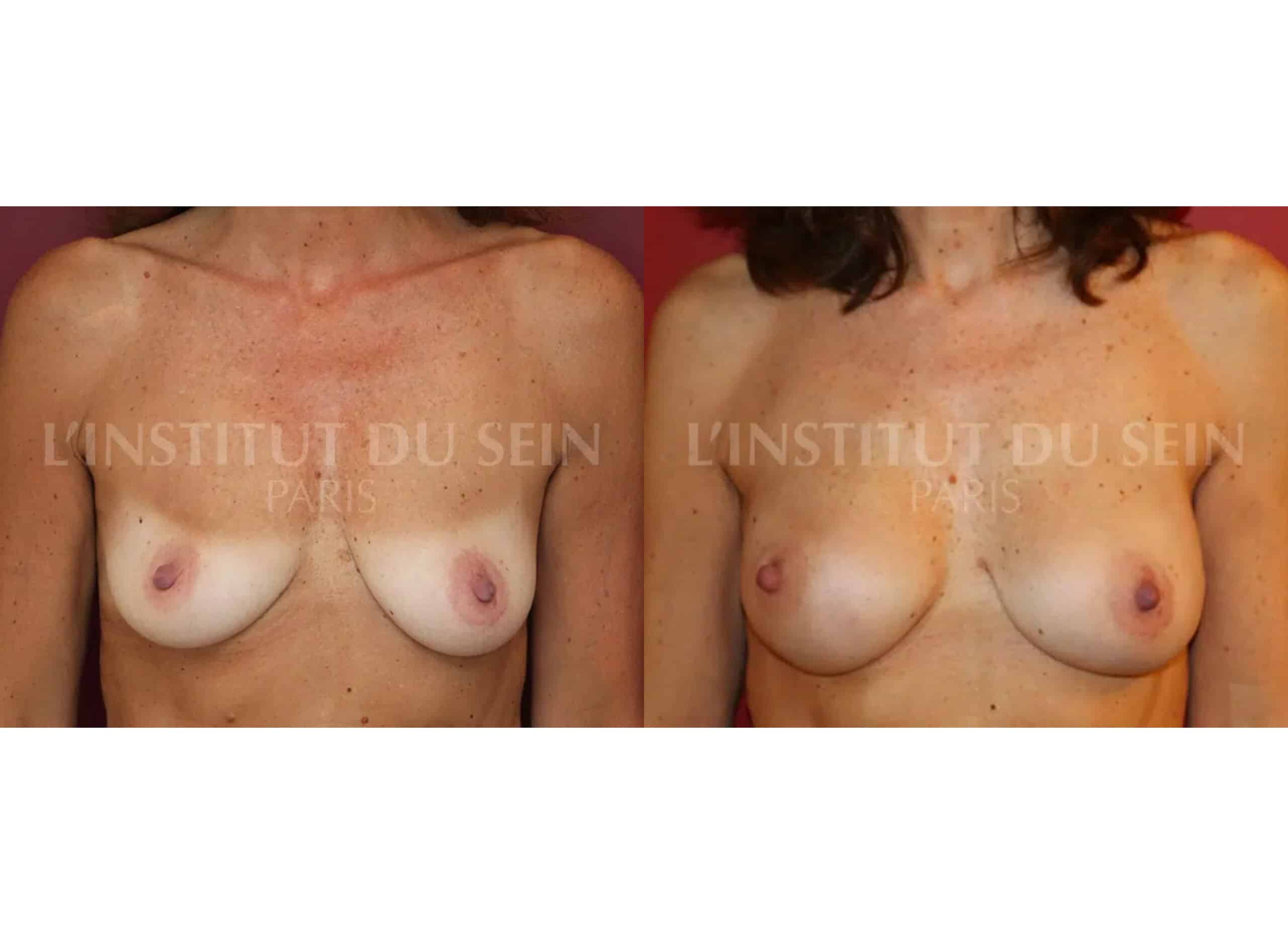 Des seins avec mastectomie prophylactique bilaterale avant une reconstruction par protheses a l'institut du sein paris