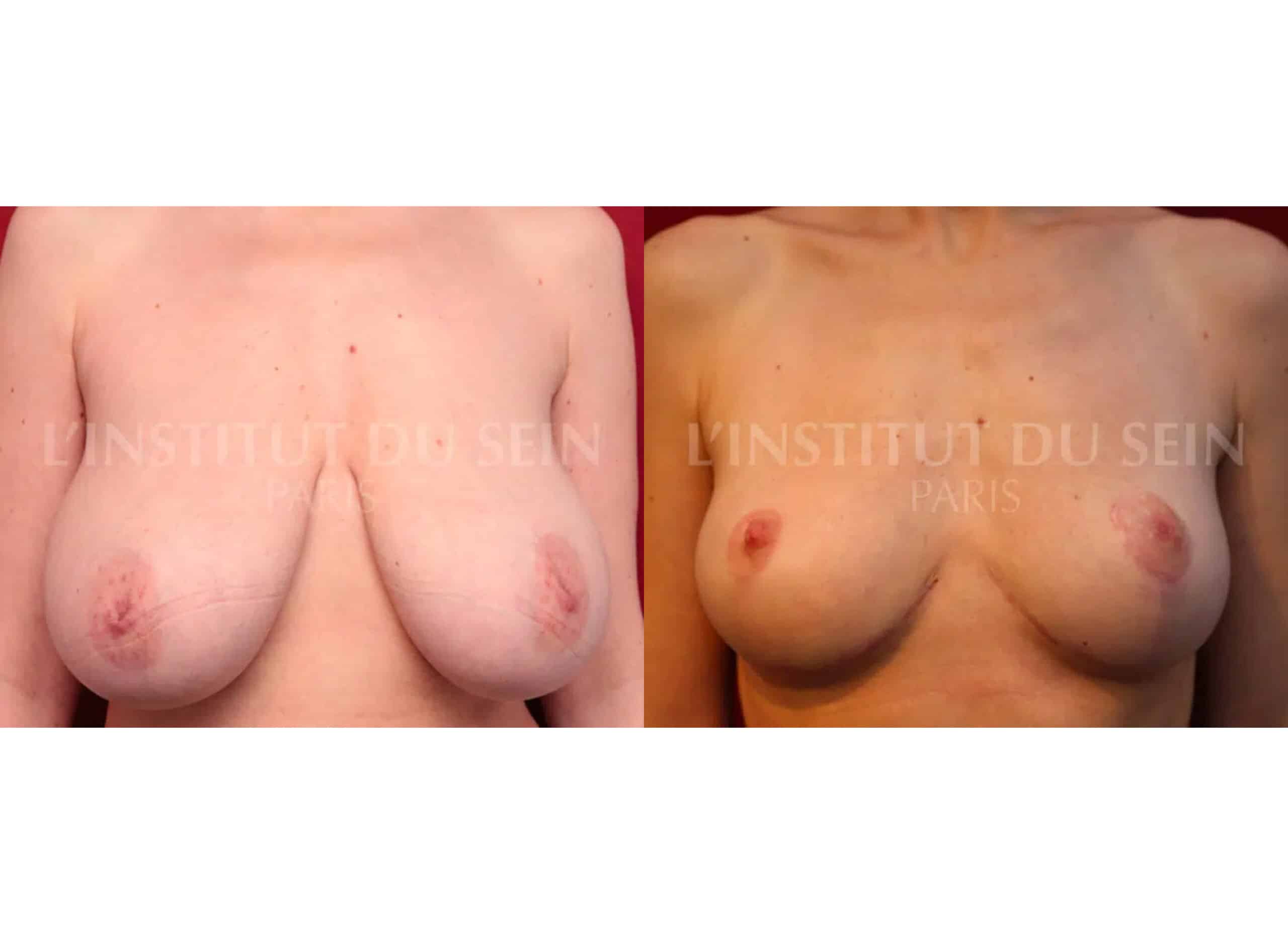 Cure de ptose par cicatrices en T inversé_